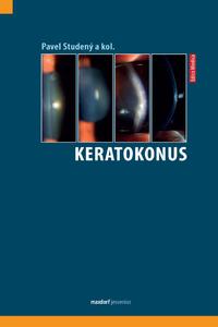 Keratokonus